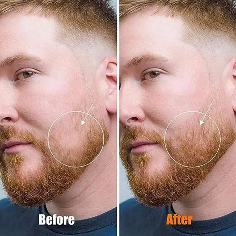 Micro Needling 540 Roller Derma Roller Dermaroller 0.2/0.25/0.3Mm Titanium Hair Regrowth Beard Growth Anti-Hair Loss Treatment